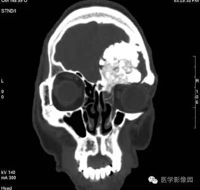 【病例】颅骨骨化性纤维瘤1例CT影像表现 【病例】颅骨骨化性纤维瘤1例CT影像表现