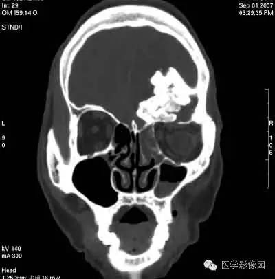 【病例】颅骨骨化性纤维瘤1例CT影像表现 【病例】颅骨骨化性纤维瘤1例CT影像表现