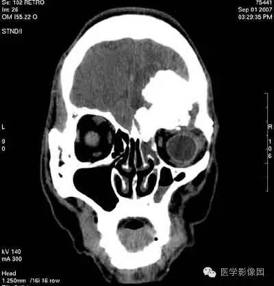 【病例】颅骨骨化性纤维瘤1例CT影像表现 【病例】颅骨骨化性纤维瘤1例CT影像表现