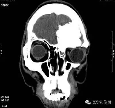 【病例】颅骨骨化性纤维瘤1例CT影像表现 【病例】颅骨骨化性纤维瘤1例CT影像表现