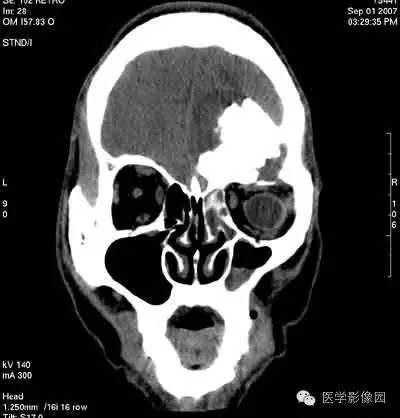 【病例】颅骨骨化性纤维瘤1例CT影像表现 【病例】颅骨骨化性纤维瘤1例CT影像表现