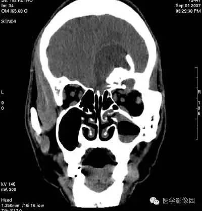 【病例】颅骨骨化性纤维瘤1例CT影像表现 【病例】颅骨骨化性纤维瘤1例CT影像表现