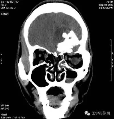 【病例】颅骨骨化性纤维瘤1例CT影像表现 【病例】颅骨骨化性纤维瘤1例CT影像表现