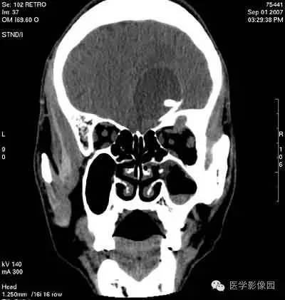 【病例】颅骨骨化性纤维瘤1例CT影像表现 【病例】颅骨骨化性纤维瘤1例CT影像表现