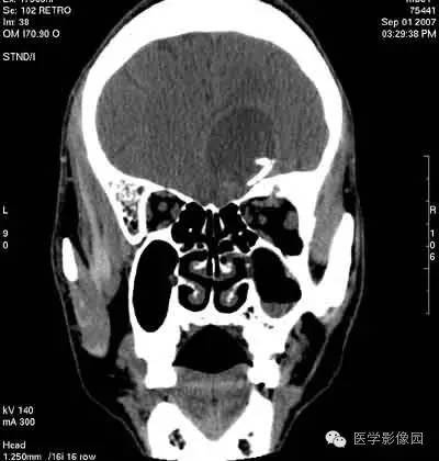【病例】颅骨骨化性纤维瘤1例CT影像表现 【病例】颅骨骨化性纤维瘤1例CT影像表现