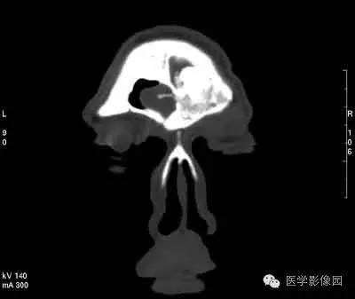【病例】颅骨骨化性纤维瘤1例CT影像表现 【病例】颅骨骨化性纤维瘤1例CT影像表现