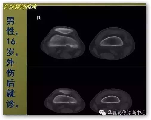 【病例】股骨远端骨膜硬纤维瘤1例影像表现