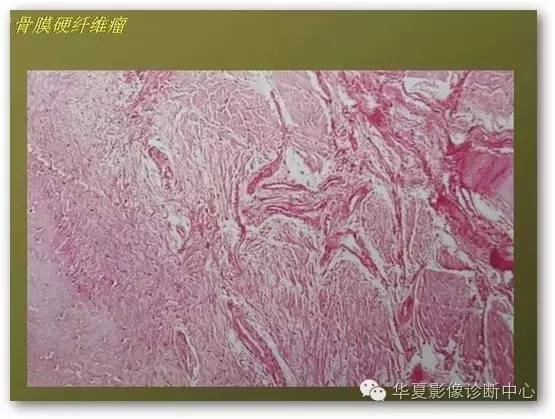 【病例】股骨远端骨膜硬纤维瘤1例影像表现
