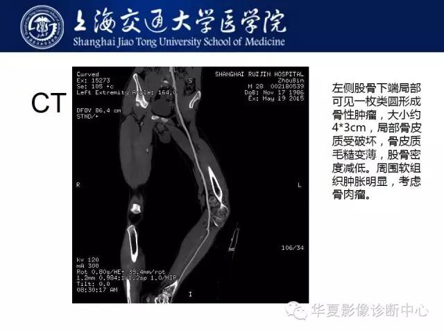 【病例】股骨远端骨肉瘤1例影像表现