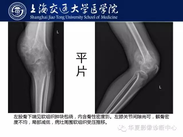 【病例】股骨远端骨肉瘤1例影像表现