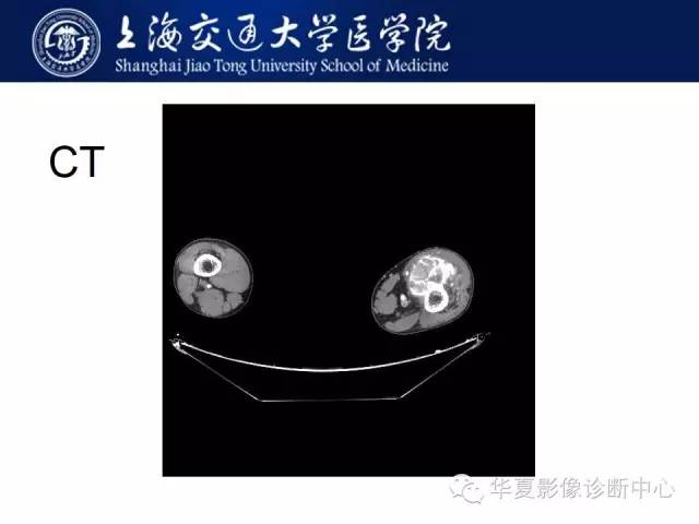 【病例】股骨远端骨肉瘤1例影像表现