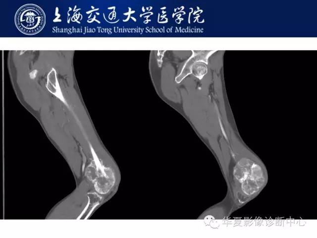 【病例】股骨远端骨肉瘤1例影像表现