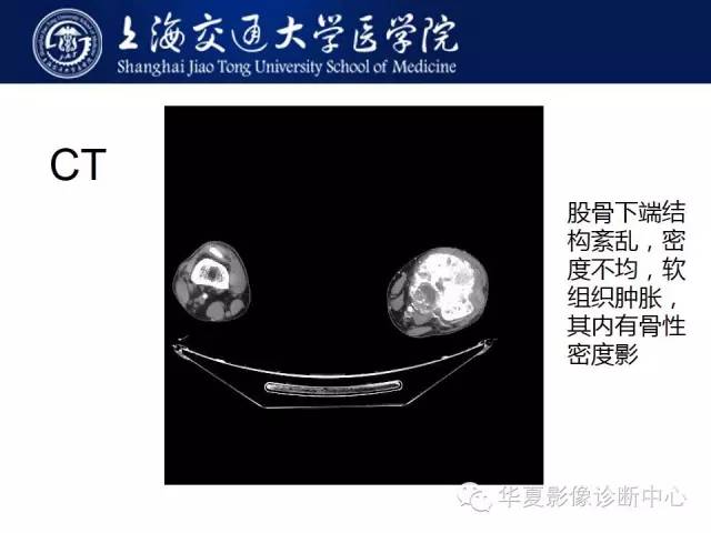 【病例】股骨远端骨肉瘤1例影像表现