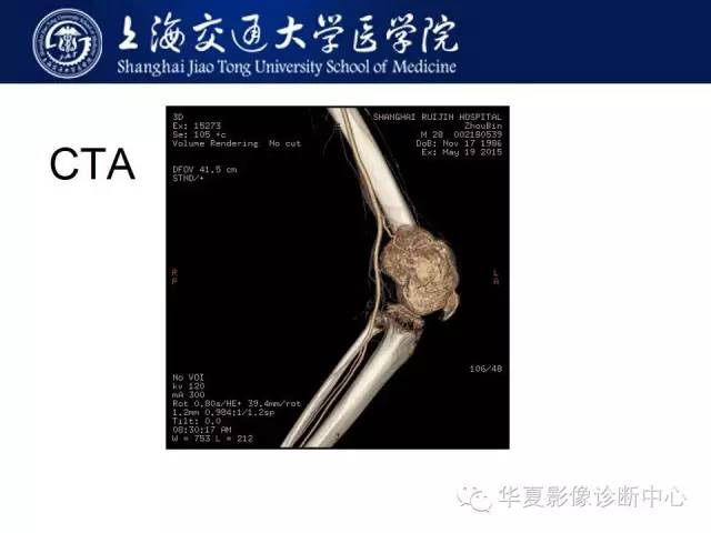 【病例】股骨远端骨肉瘤1例影像表现