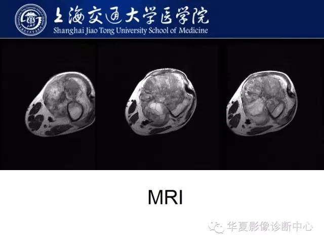 【病例】股骨远端骨肉瘤1例影像表现