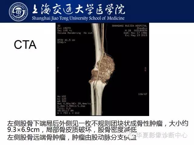 【病例】股骨远端骨肉瘤1例影像表现