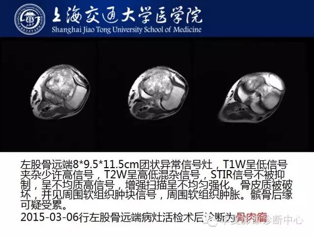 【病例】股骨远端骨肉瘤1例影像表现