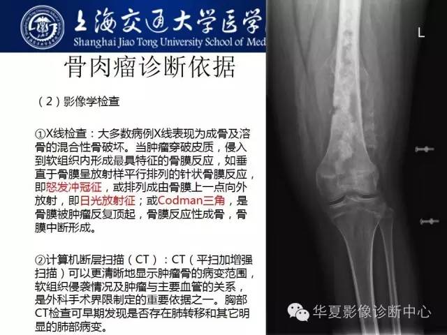 【病例】股骨远端骨肉瘤1例影像表现