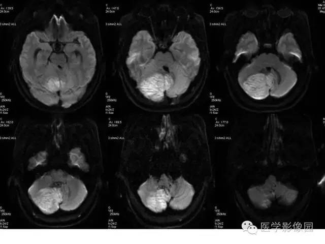 【病例】小脑发育不良性节细胞瘤1例MR影像表现