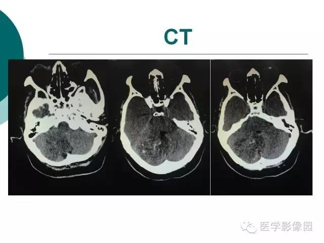 【病例】小脑发育不良性节细胞瘤1例MR影像表现