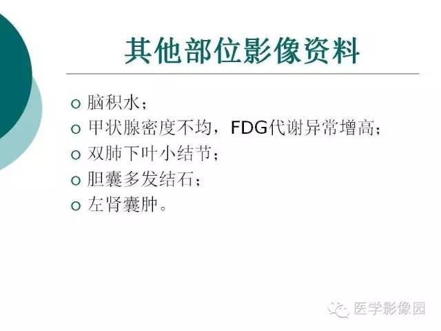 【病例】小脑发育不良性节细胞瘤1例MR影像表现