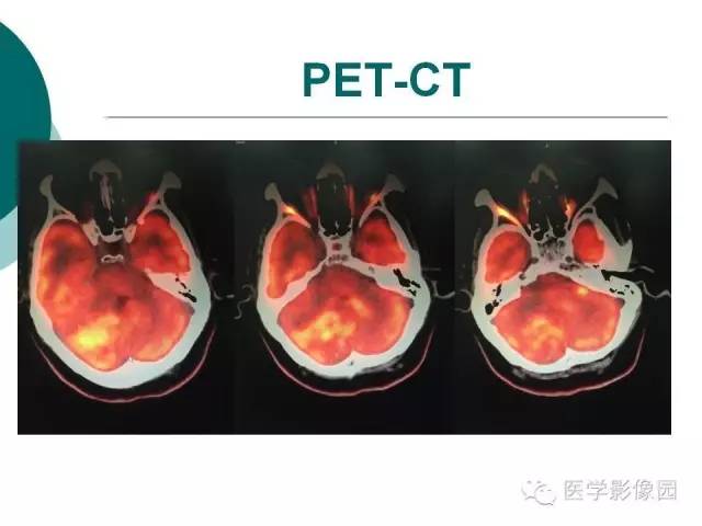 【病例】小脑发育不良性节细胞瘤1例MR影像表现