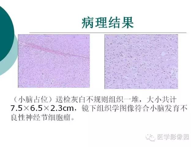 【病例】小脑发育不良性节细胞瘤1例MR影像表现