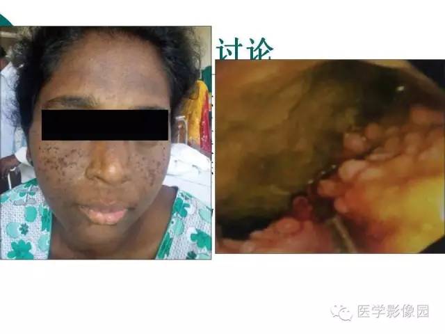 【病例】小脑发育不良性节细胞瘤1例MR影像表现