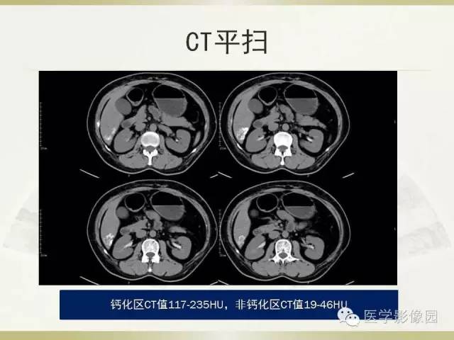 【病例】肝脏孤立性坏死结节1例CT及MR影像表现