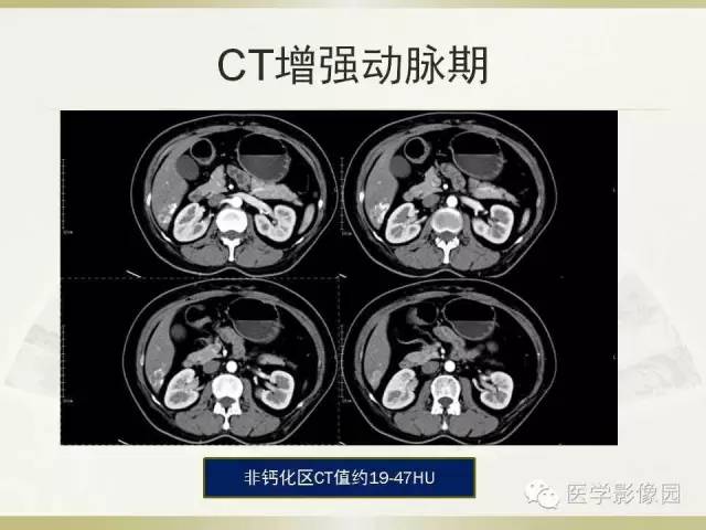 【病例】肝脏孤立性坏死结节1例CT及MR影像表现