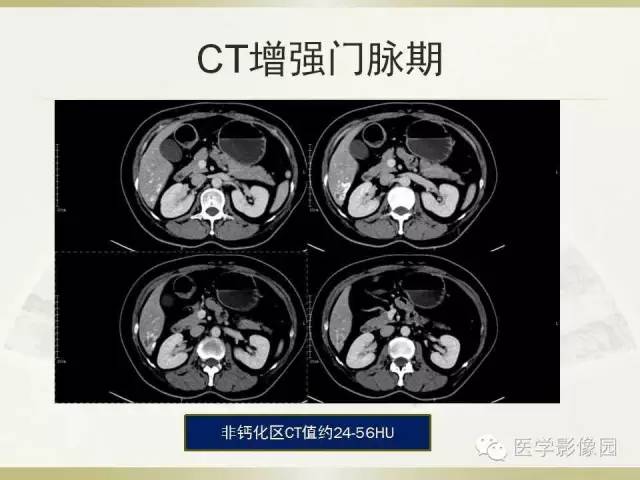 【病例】肝脏孤立性坏死结节1例CT及MR影像表现