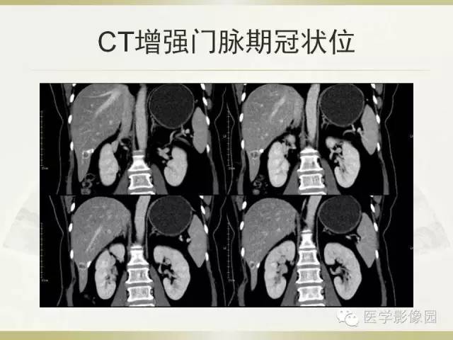 【病例】肝脏孤立性坏死结节1例CT及MR影像表现