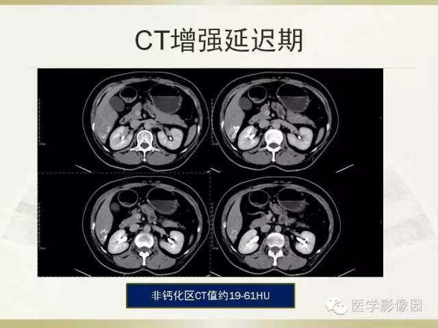 【病例】肝脏孤立性坏死结节1例CT及MR影像表现