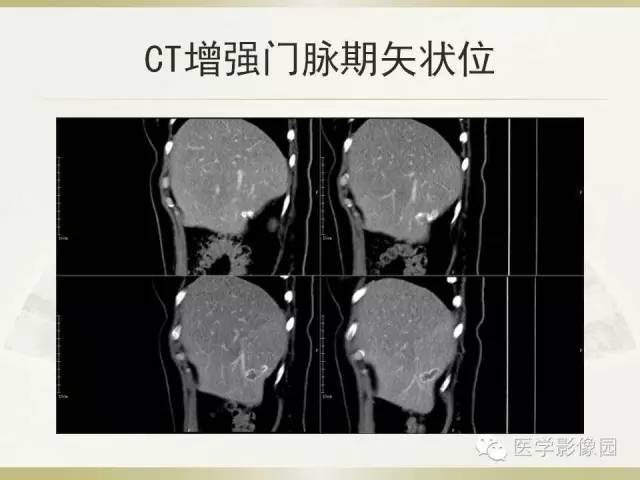 【病例】肝脏孤立性坏死结节1例CT及MR影像表现