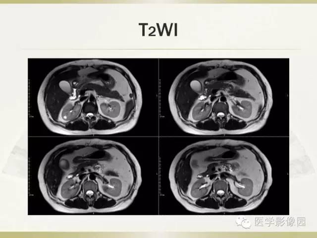 【病例】肝脏孤立性坏死结节1例CT及MR影像表现