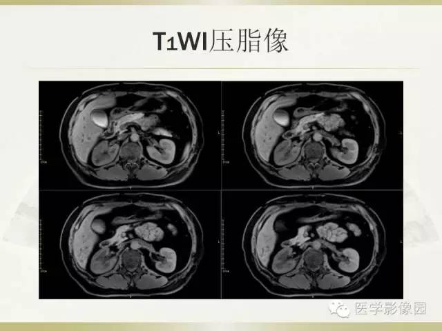 【病例】肝脏孤立性坏死结节1例CT及MR影像表现