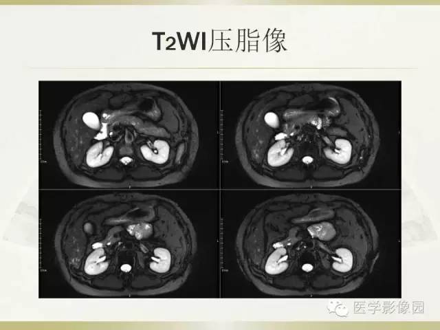 【病例】肝脏孤立性坏死结节1例CT及MR影像表现