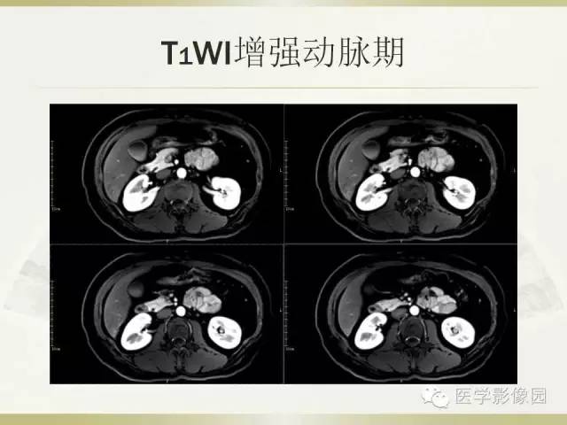 【病例】肝脏孤立性坏死结节1例CT及MR影像表现