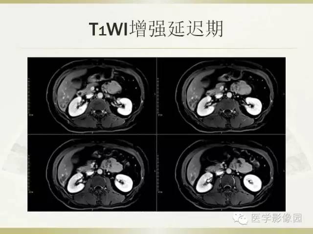【病例】肝脏孤立性坏死结节1例CT及MR影像表现