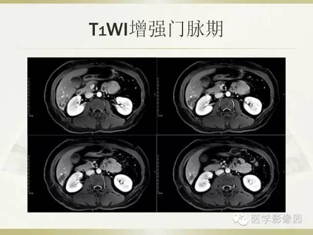 【病例】肝脏孤立性坏死结节1例CT及MR影像表现
