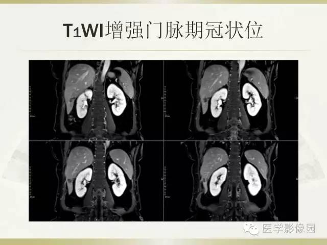 【病例】肝脏孤立性坏死结节1例CT及MR影像表现