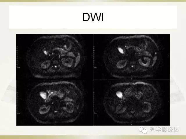 【病例】肝脏孤立性坏死结节1例CT及MR影像表现