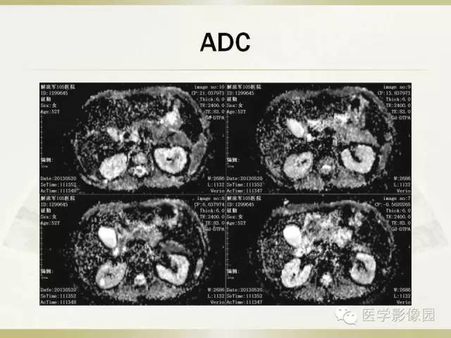 【病例】肝脏孤立性坏死结节1例CT及MR影像表现