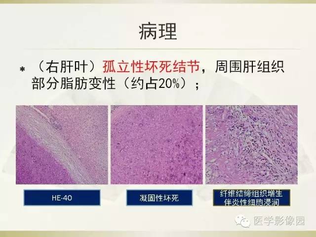 【病例】肝脏孤立性坏死结节1例CT及MR影像表现