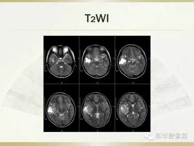 【病例】右颞叶多形性黄色星形细胞瘤1例MR影像表现