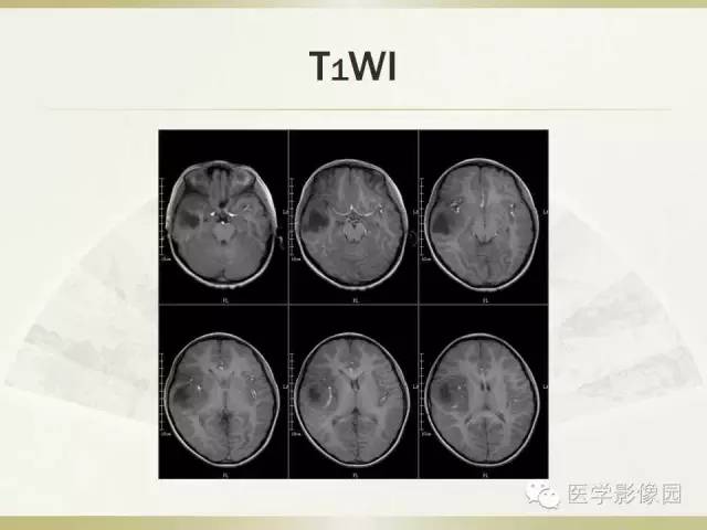 【病例】右颞叶多形性黄色星形细胞瘤1例MR影像表现
