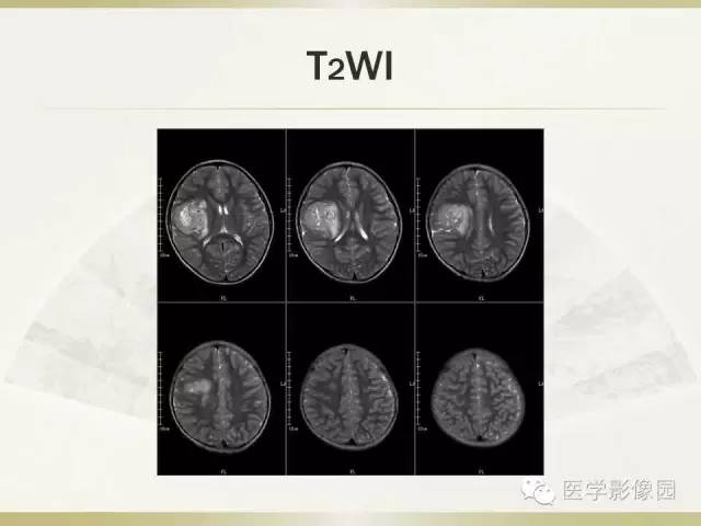 【病例】右颞叶多形性黄色星形细胞瘤1例MR影像表现