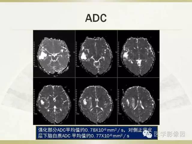 【病例】右颞叶多形性黄色星形细胞瘤1例MR影像表现