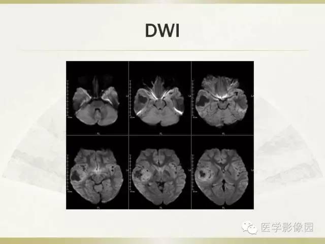 【病例】右颞叶多形性黄色星形细胞瘤1例MR影像表现