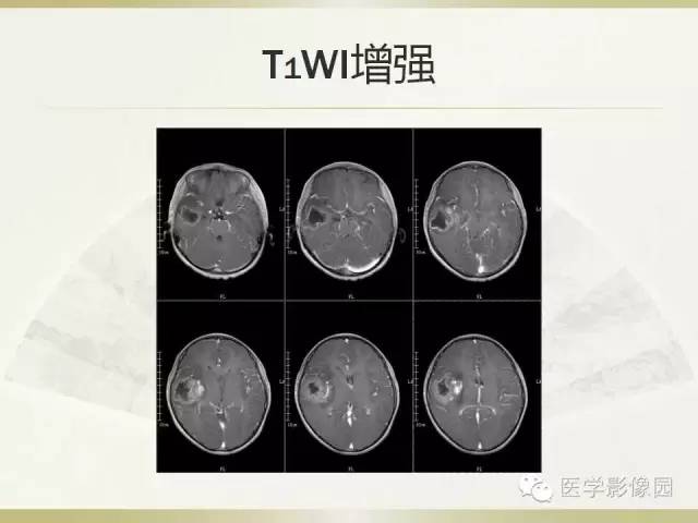 【病例】右颞叶多形性黄色星形细胞瘤1例MR影像表现